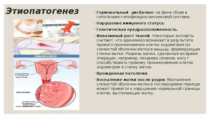 Аденомиоз: симптомы, степени, лечение | eurolab | гинекология