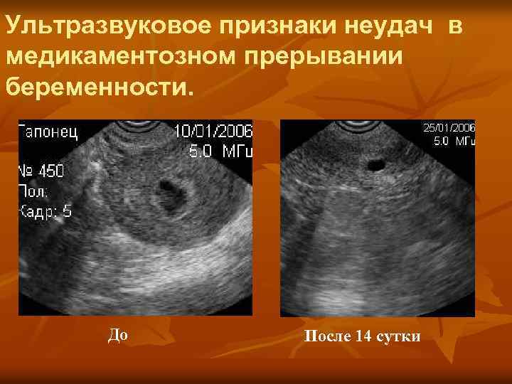 Беременность после аборта - каковы шансы и возможные последствия