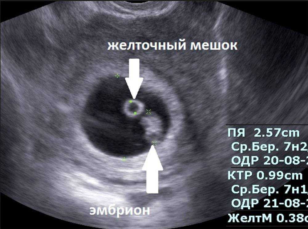 Где находится матка при беременности на ранних сроках фото