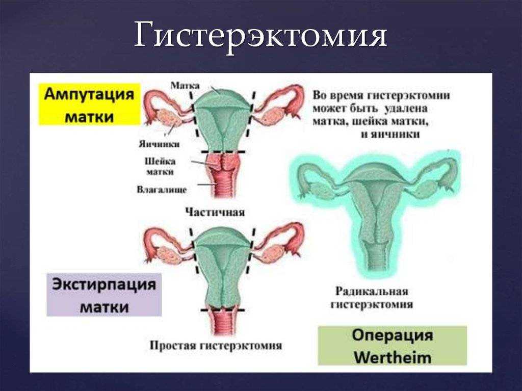 Апоплексия яичника