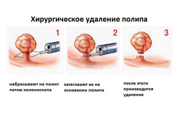 Можно ли забеременеть с полипом в матке? | санкт-петербург, клиника "неомед", (812) 249-0-249