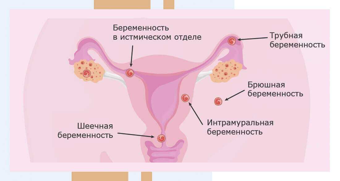 Беременность без маточных труб возможна!