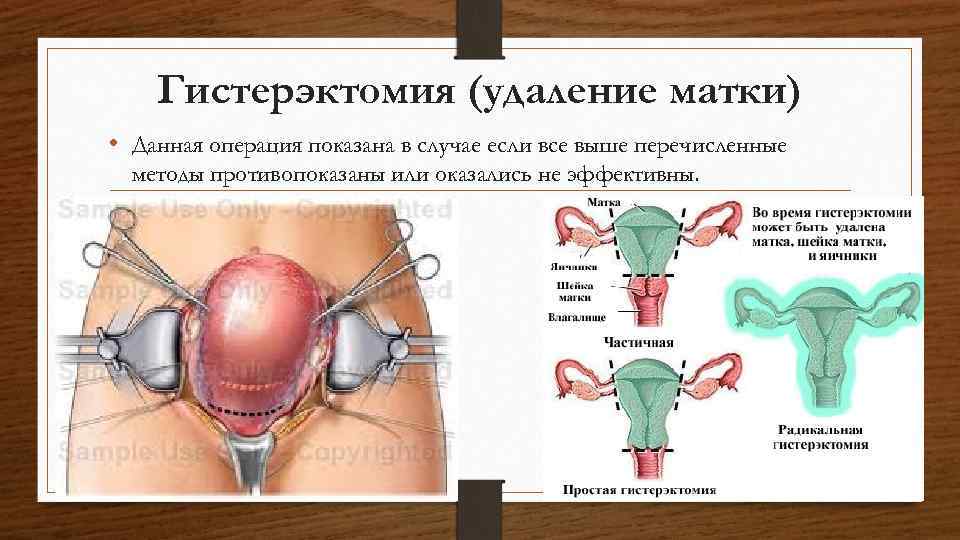 Реабилитация после удаления миомы матки