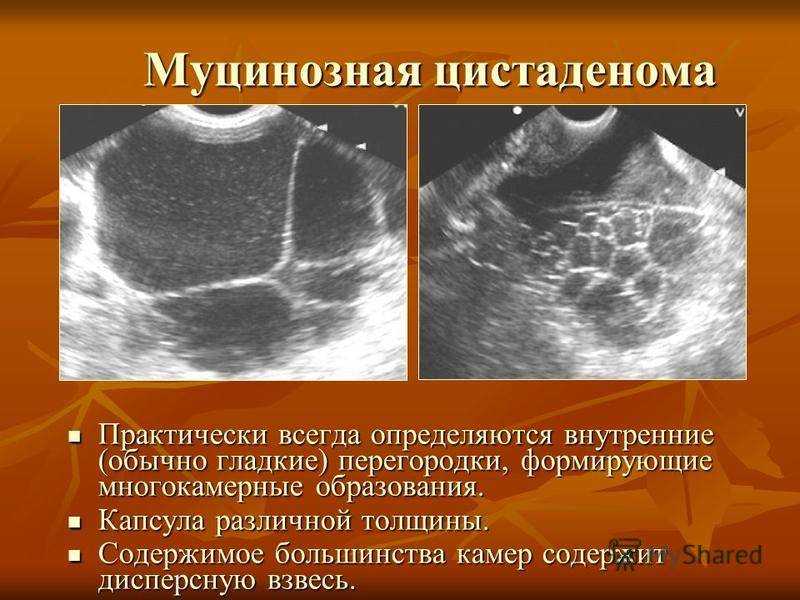 Эхографическое изображение злокачественной опухоли чаще представляет собой образование