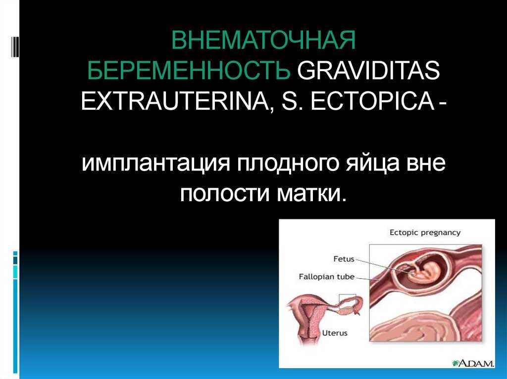 Забеременеть после внематочной беременности с одной трубой. Эктопическая Трубная беременность. Внематочная или эктопическая беременность. Внематочная (эктопическая) беременность. Внематочная беременность плодное яйцо.