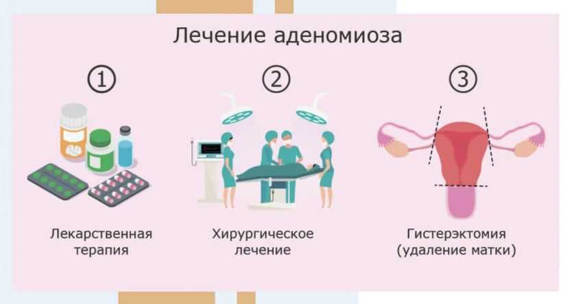 Симптомы и лечение аденомиоза - medside.ru
