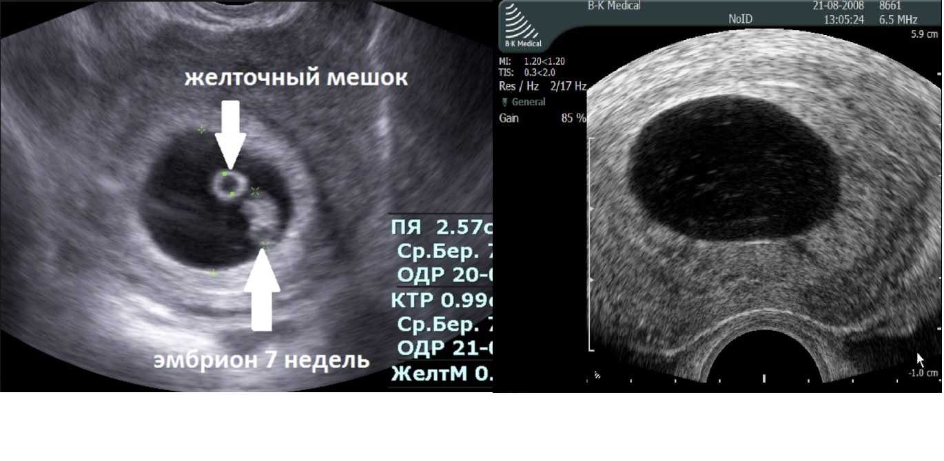 Почему не видно эмбрион. Снимок УЗИ пустого плодного яйца. Плодное яйцо с эмбрионом и желточным мешком. УЗИ неразвивающейся беременности 6 недель.
