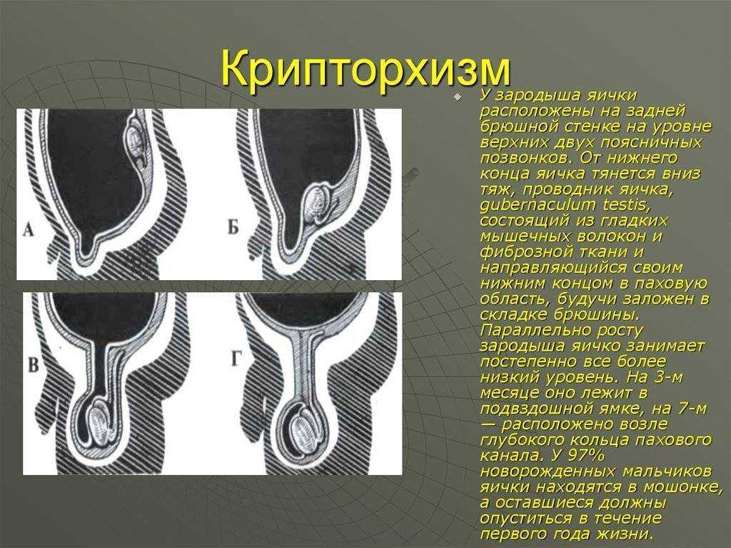 Перекрут яичка - диагностика, симптомы | университетская клиника