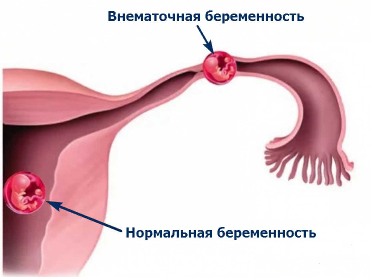 Невматочная беременность. Ампулярная внематочная беременность. Внематочная (эктопическая) беременность. Причины внематочной беременности. Внематочная беременность по типу трубного аборта.