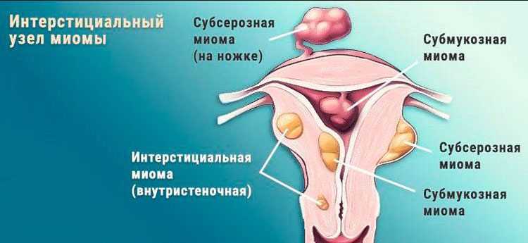 Миома матки презентация гинекология