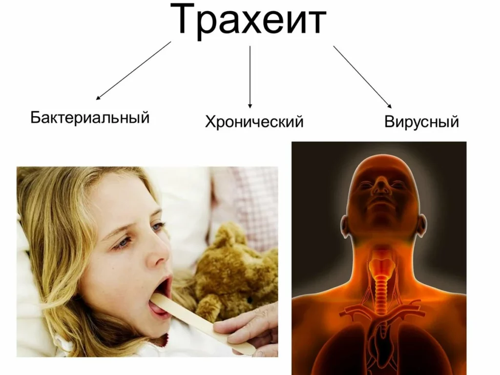 Трахеит у детей фото