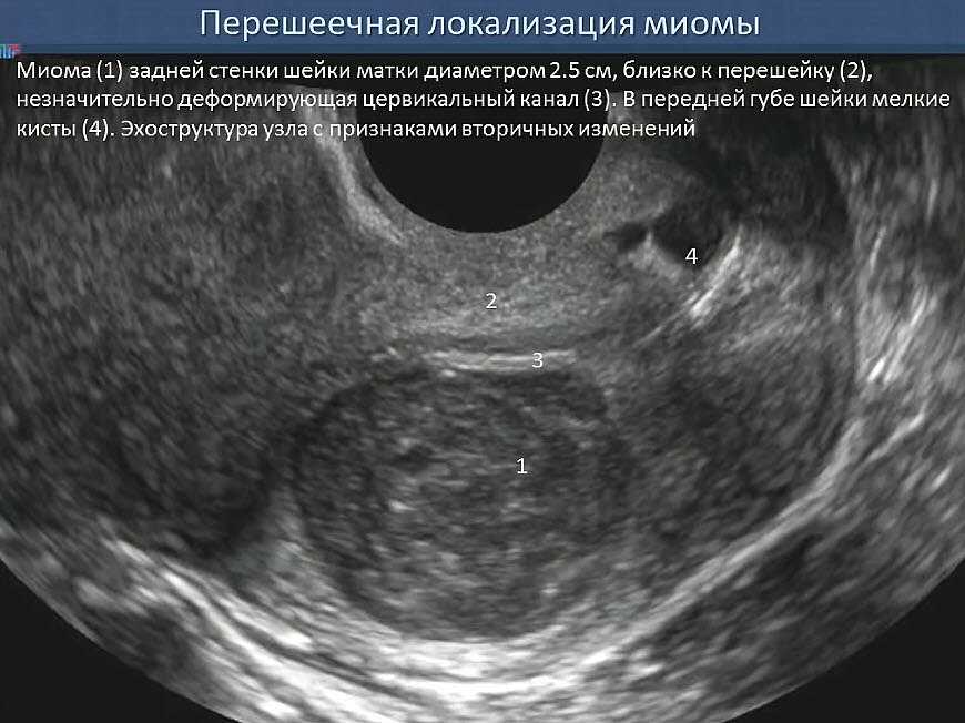 Миома на задней стенке матки встречается достаточно часто Мима матки задней стенки проявляется также, как и новообразование на других участках Миому матки по задней стенке лечат так же, как и на передней