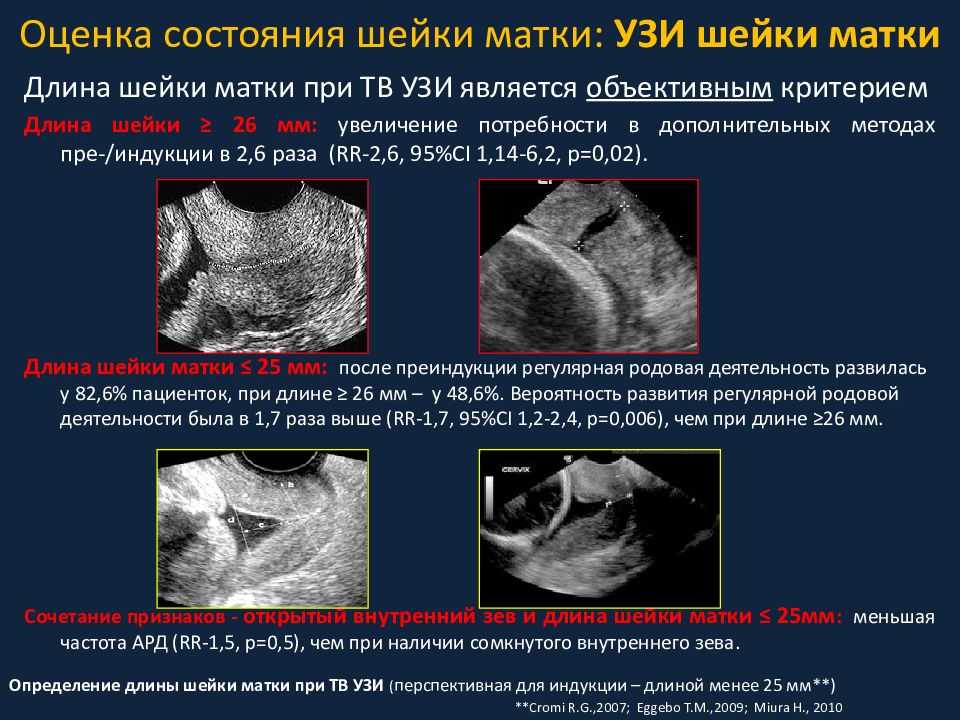 Короткая матка. Ультразвуковое исследование шейки матки УЗИ-цервикометрия. Истмико-цервикальная недостаточность на УЗИ. Размеры шейки матки на УЗИ норма. Измерение шейки матки на УЗИ.