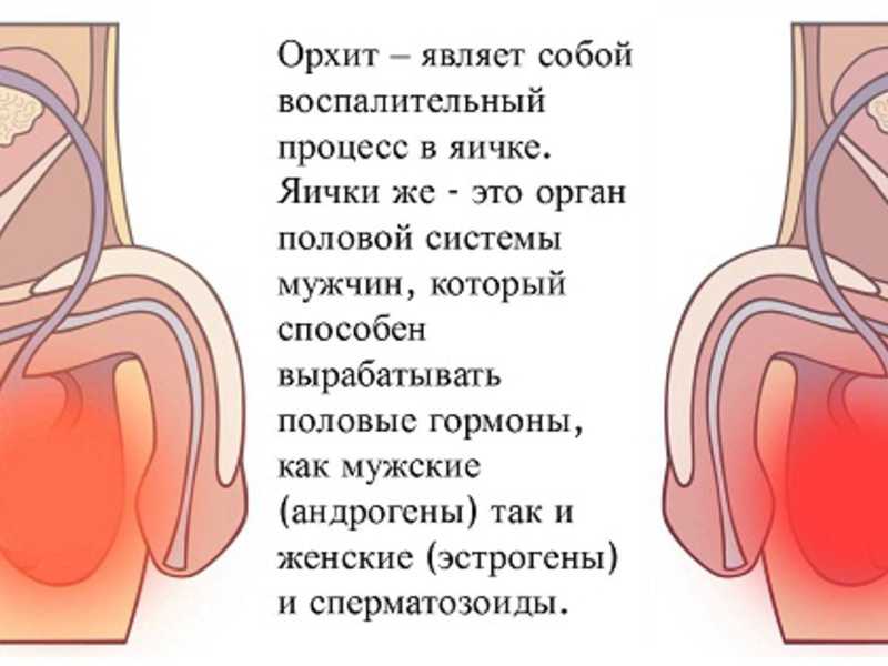 Боль внизу яичка у мужчин. Орхит (воспаление яичка).