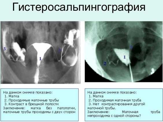Гистеросальпингография. диагностическая гистеросальпингография при бесплодии, показания, противопоказания :: polismed.com