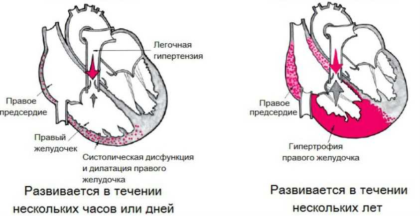 Хроническое легочное сердце. Синдром хронического легочного сердца. Острое и хроническое легочное сердце. Клинические проявления острое легочное сердце. Хрон легочное сердце.