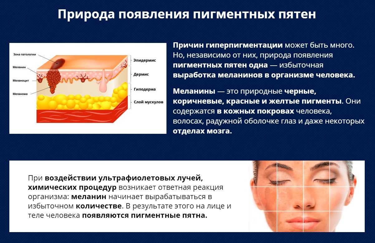 Лечение мелазмы – рекомендации британской ассоциации дерматологов (перевод и адаптация проф. святенко)