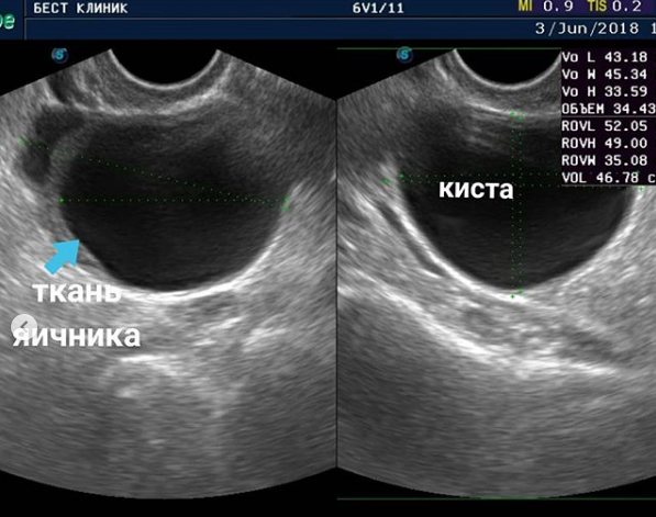 Киста яичника на узи фото у женщин лечение