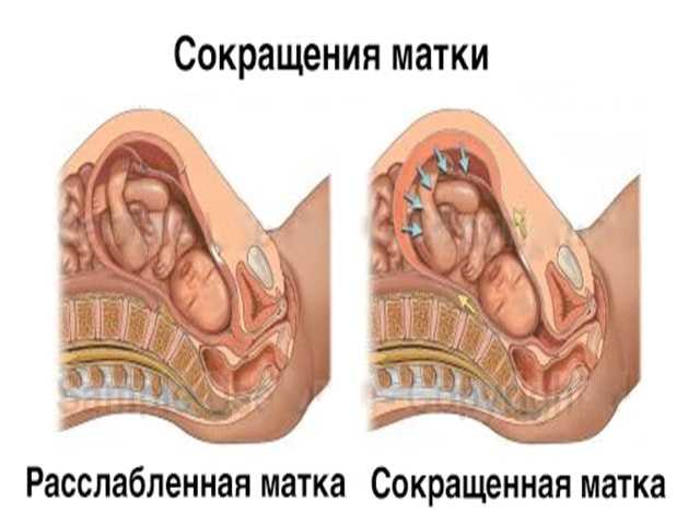 Субинволюция матки: почему не сокращается матка и чем это опасно * клиника диана в санкт-петербурге