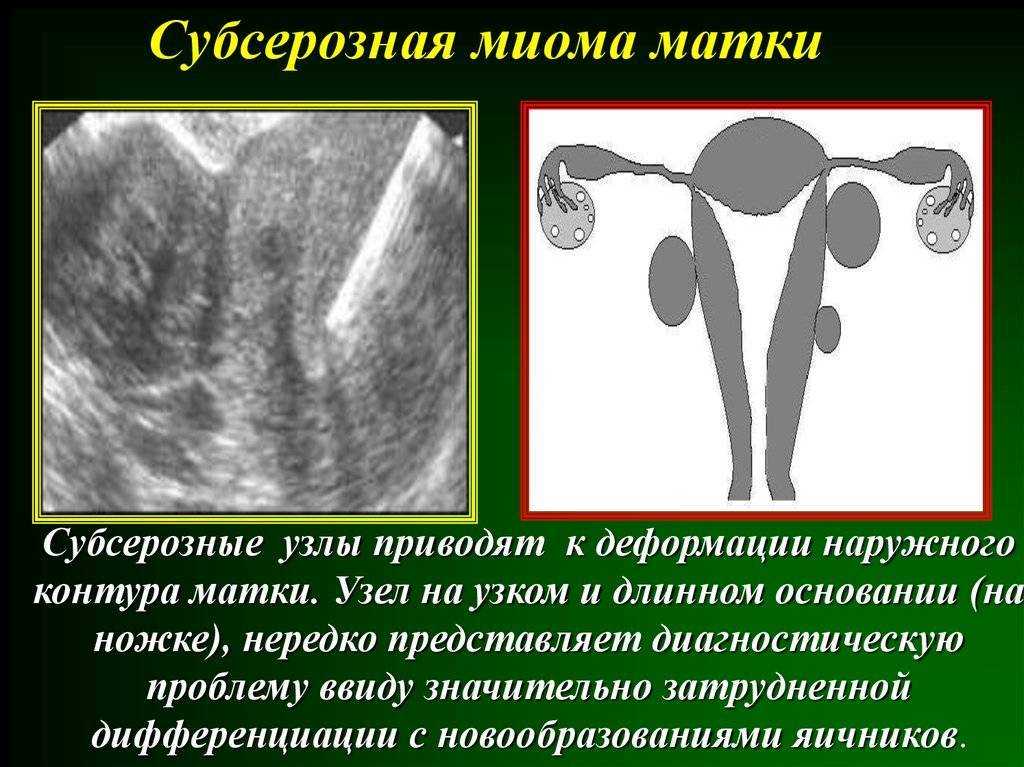 Полость матки деформирована. Основной клинический симптом субсерозной миомы. Субсерозные миоматозные узлы матки что. Миома матки субсерозный узел.