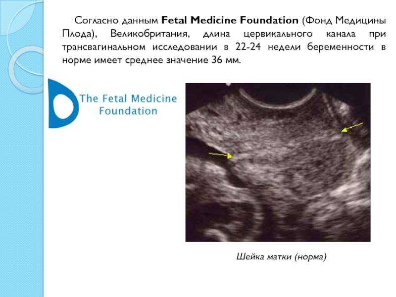 Шейка мм 31 неделя. Цервикальный канал при беременности норма 20 недель. Короткая шейка матки 28 мм при беременности. Шейка матки при беременности УЗИ. Ширина цервикального канала в норме.