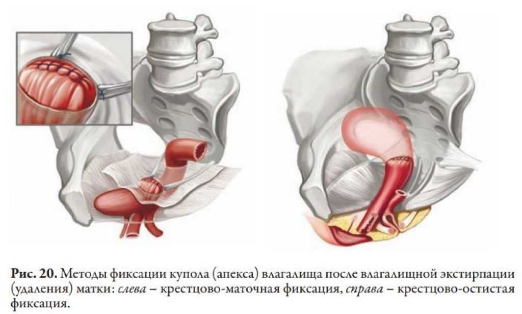 Операция опущения стенок матки. Операции при полном выпадении матки. Пролапс органов малого таза операция. Операции при выпадении влагалища. Опущение влагалища операция.