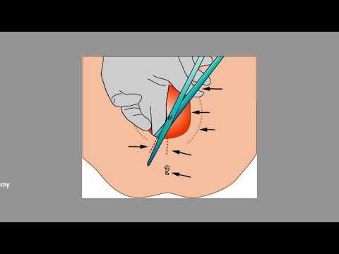 Кесарево сечение: разрез,швы, обработка, уход после операции