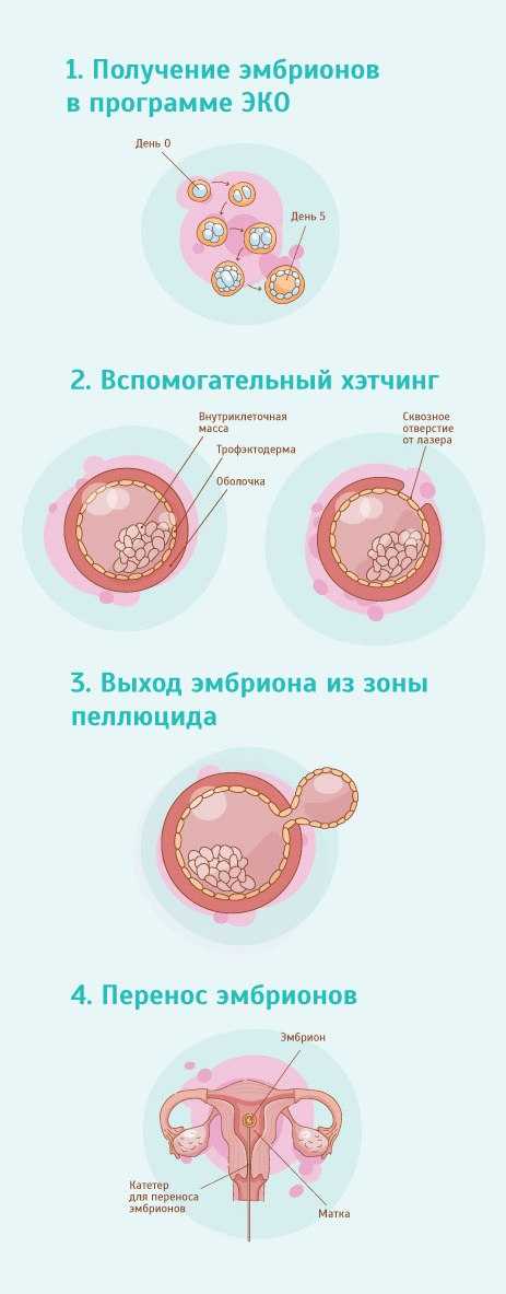 Криоперенос эмбрионов при эко