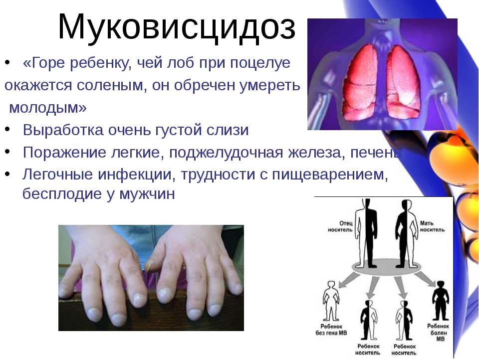 Генетическая диагностика муковисцидоза. анализ гена cftr (25 мутаций): исследования в лаборатории kdlmed