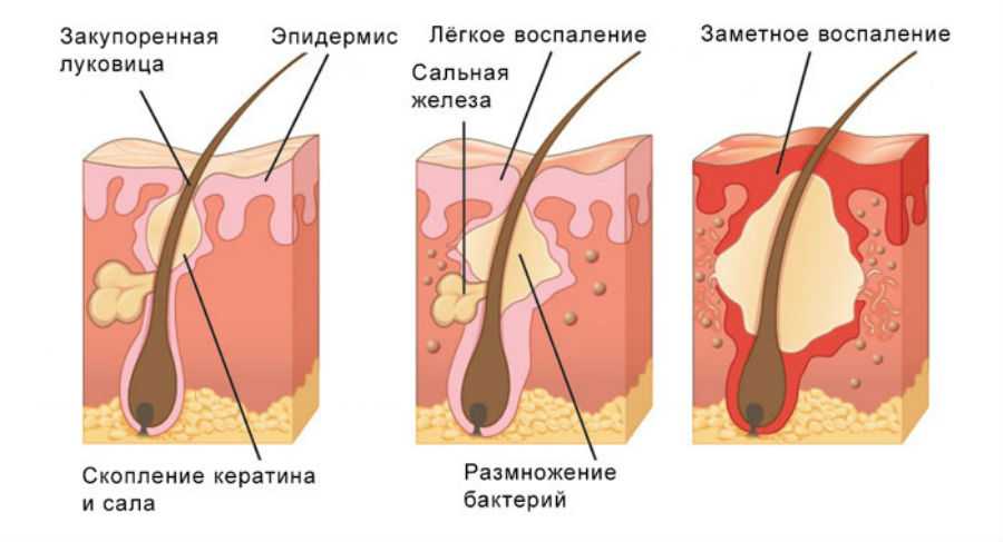 Семинома яичка: симптомы, лечение, прогноз и причины опухоли яичка у мужчин - medside.ru