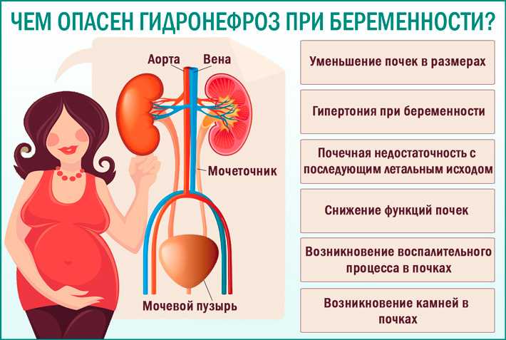 Биохимическая беременность