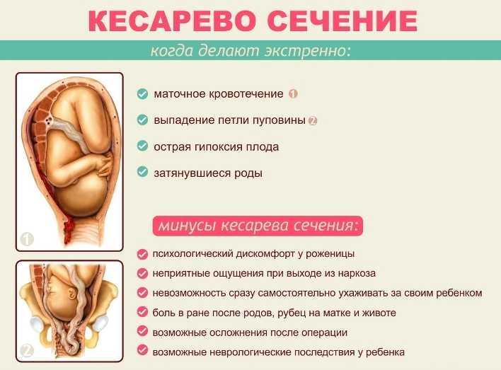 Плановое кесарево: подготовка, на каком сроке делают, как, чем отличается от экстренного, сколько по времени делают