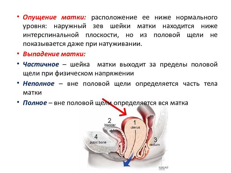 Опущение стенок матки симптомы и лечение и фото как это выглядит