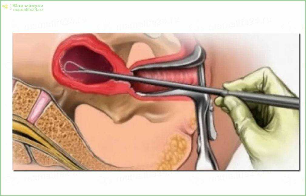 Абляция эндометрия матки что это такое фото