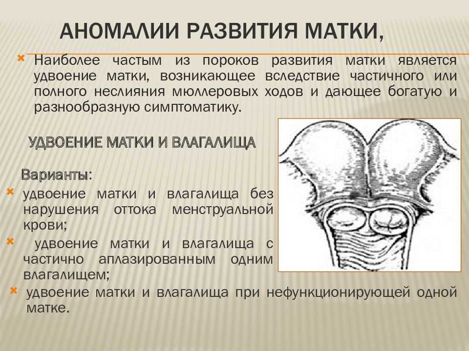 Миома матки