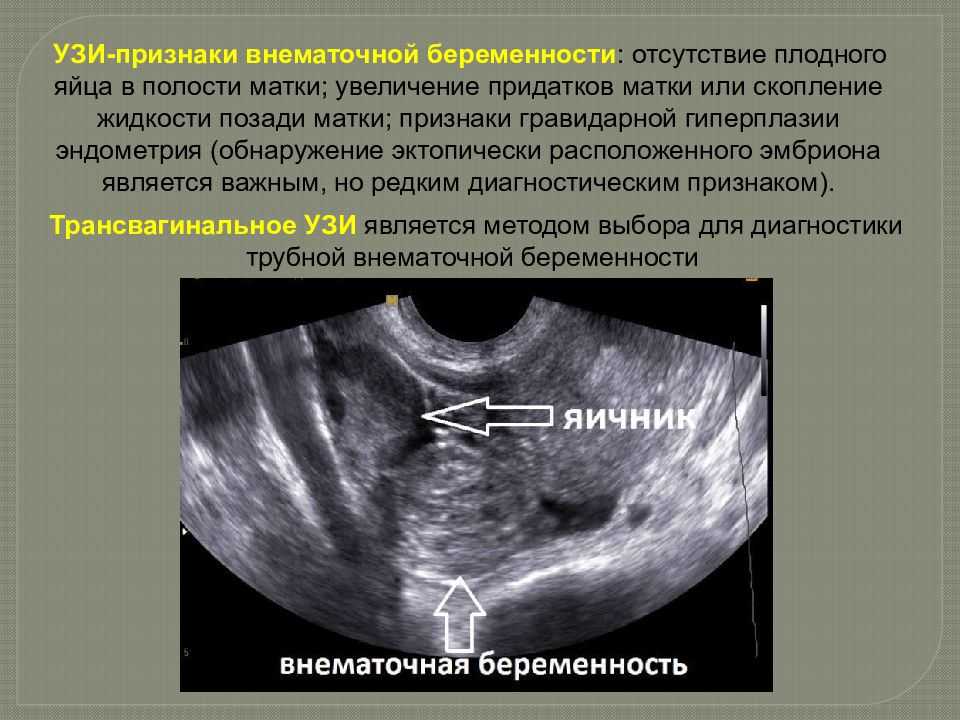 Эктопическая беременность. Внематочная беременность на УЗИ. Признаки внематочной беременности. Внематочная беременность симптомы. Признаки беременности на УЗИ.