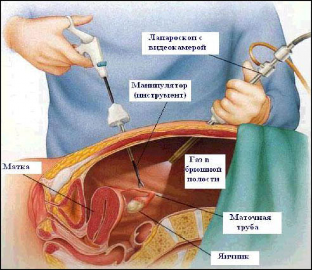 Лапароскопическая перевязка труб - лапароскопическая хирургия. контрацепция