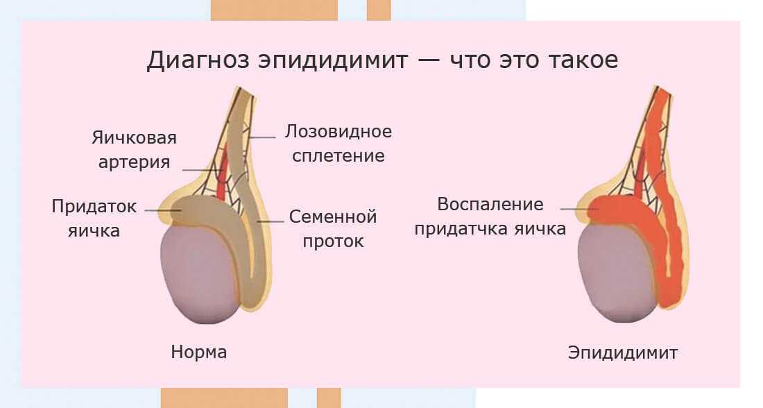 Лечение острого орхоэпидидимита у мужчин