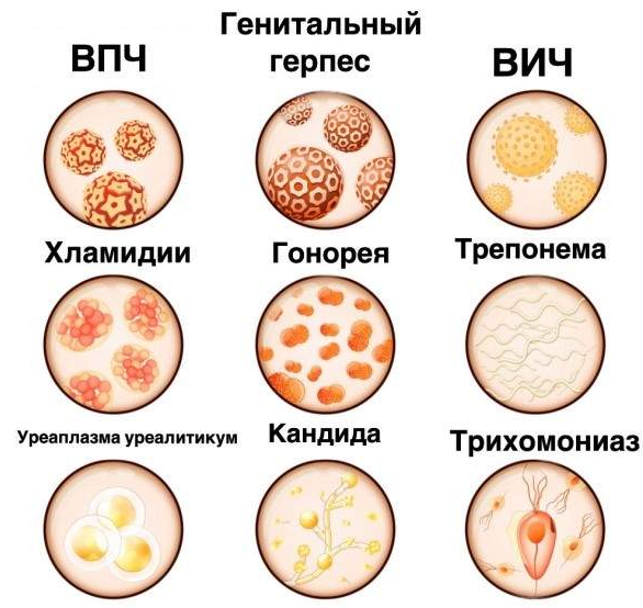 Венерологические заболевания картинки