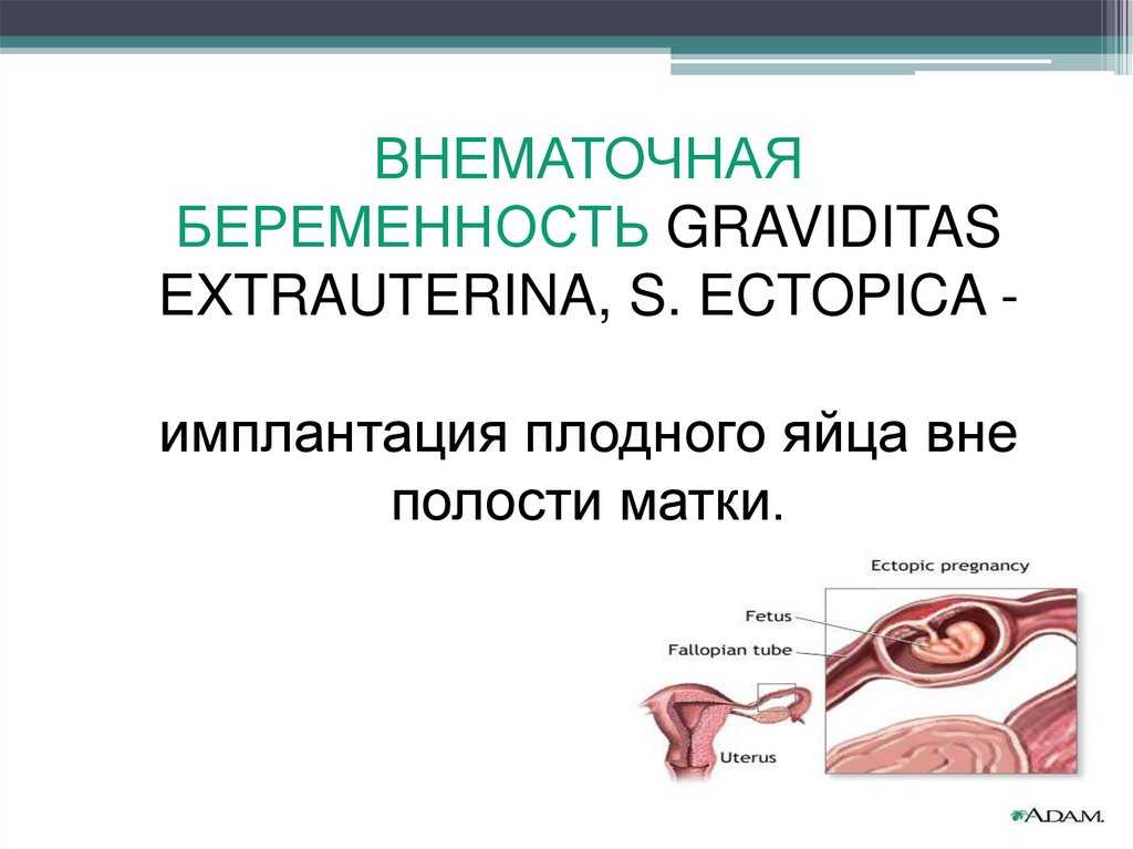 Беременность после внематочной отзывы. Клинические симптомы внематочной беременности. Причины внематочной бер. Внематочная (эктопическая) беременность. Причины внематочной беременности.