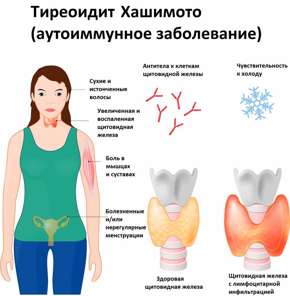 Чем опасен тиреотоксикоза: симптомы, лечение в самаре