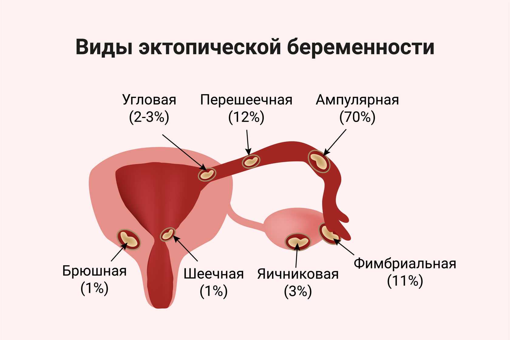 Внематочная беременность операция сроки. Внематочная беременность Трубная беременность. Шеечная внематочная беременность. Эктопическая Трубная беременность. Места локализации внематочной беременности.