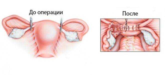 Матка женщины операция. Послеоперационные спайки.