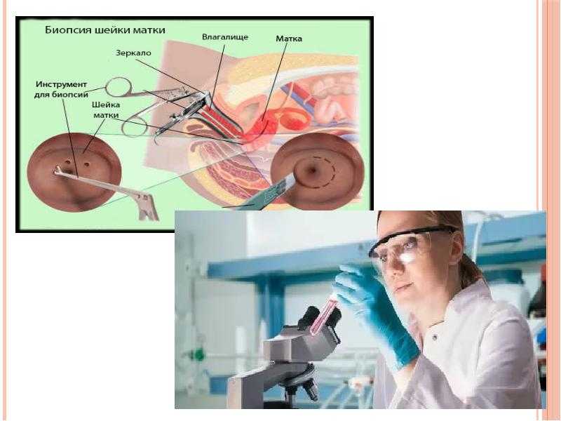 Радиоволновая биопсия шейки матки фото