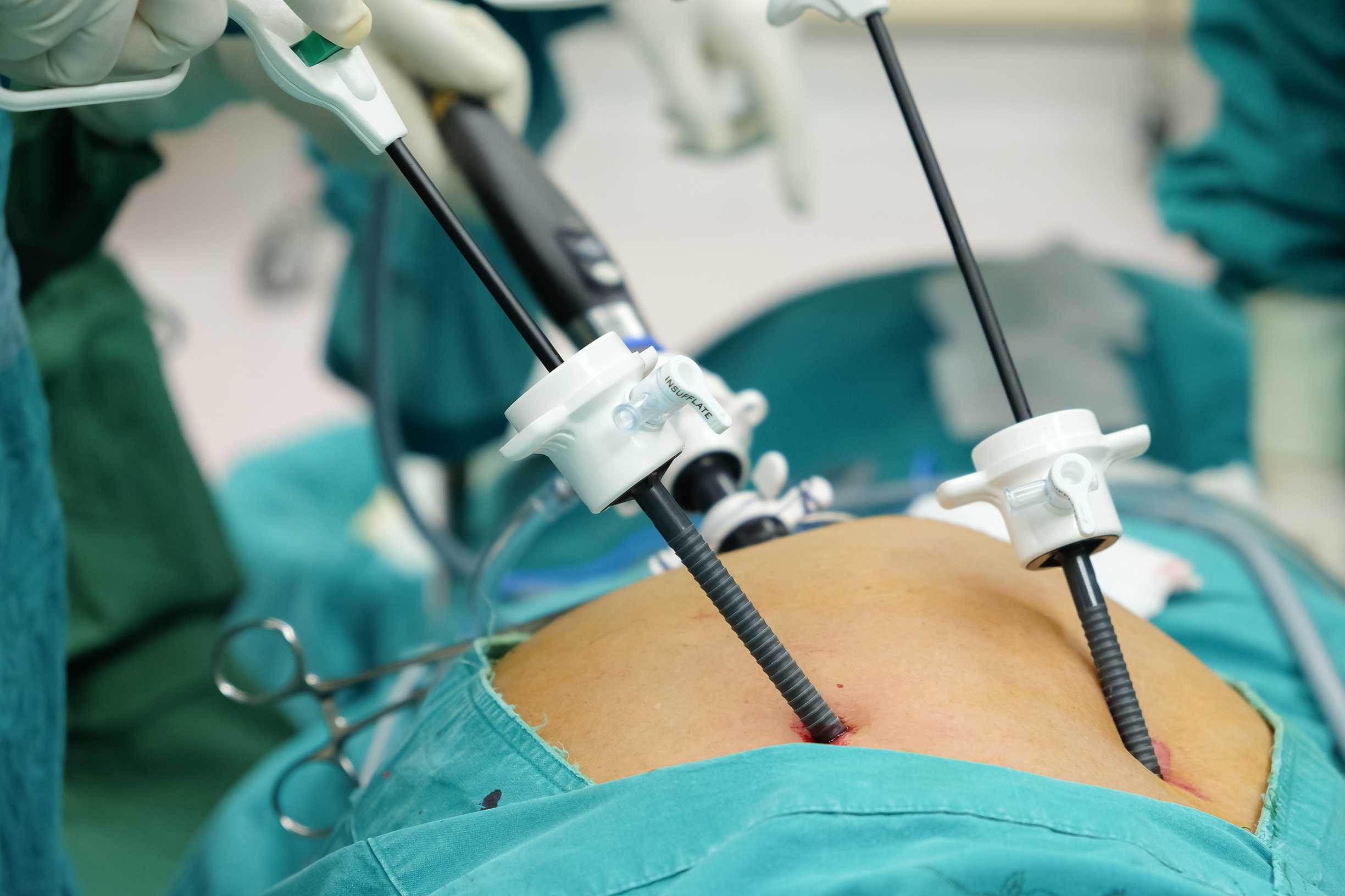 Лапароскопия матки: можно ли удалить матку и яичники лапароскопией, показания, противопоказания, видео выполнения операции