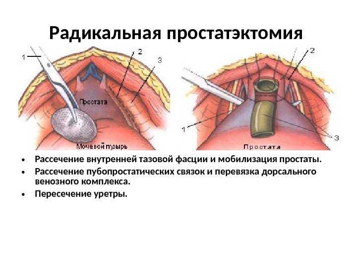 Prostata bestrahlung ablauf