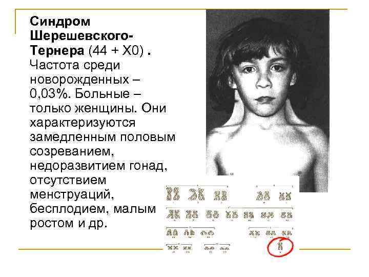 Синдром тернера (дисгенезия гонад, синдром бонневи-ульриха)   - medside.ru