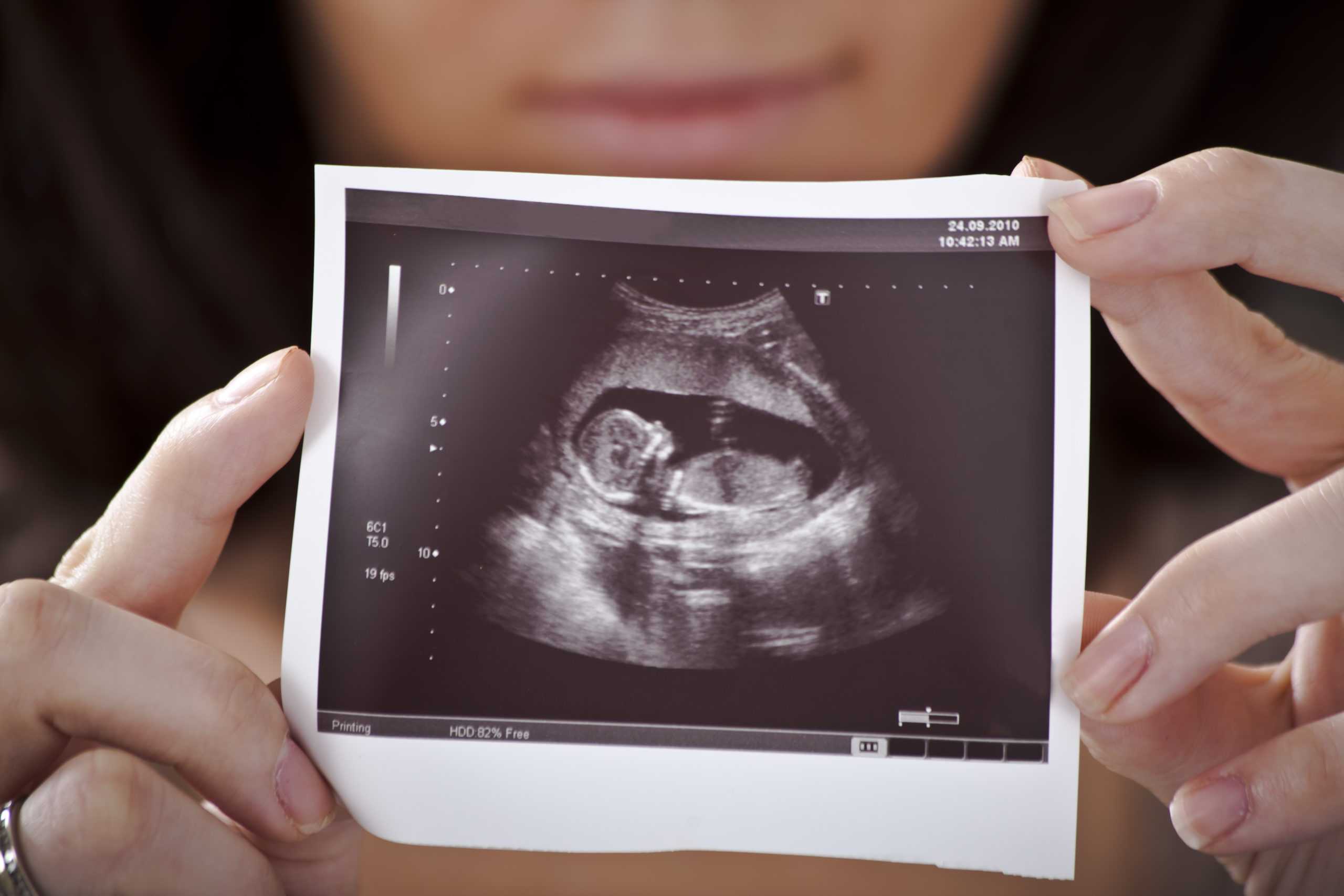 Как выглядит беременность на узи фото