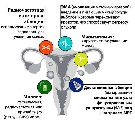 Миома матки: интерстициальная форма | лечение и профилактика развития миомы матки