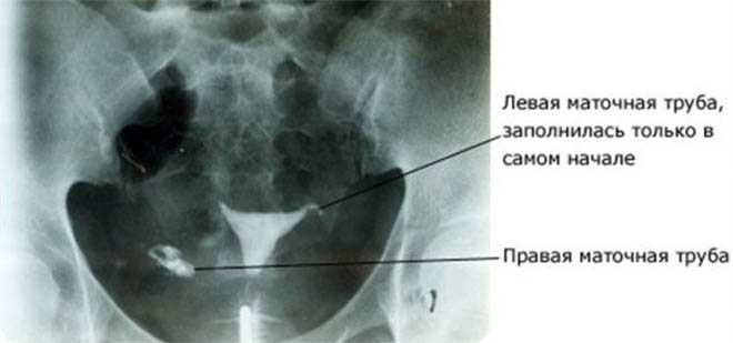 Трубы матки. ГСГ снимки маточных труб непроходимость. Снимки ГСГ С непроходимыми трубами. ГСГ снимки маточных труб. Гистеросальпингография непроходимость маточных труб.